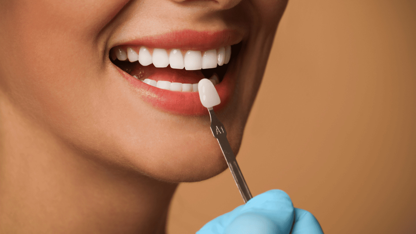 Faccette Dentali