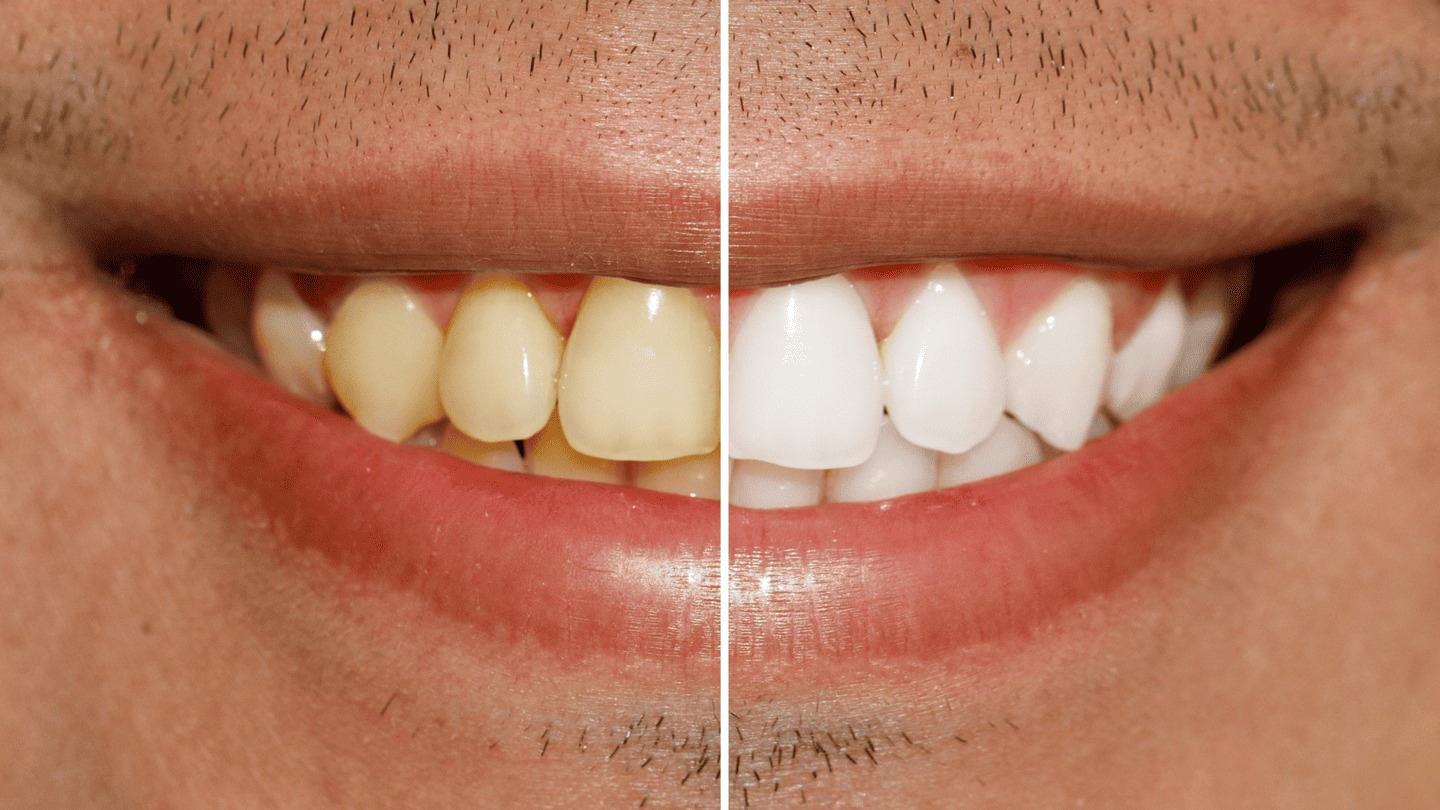 Sbiancamento Dentale