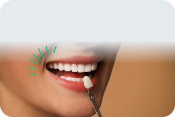 Faccette Dentali